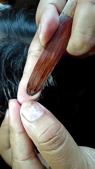 See How Many Nits Are Stuck to the Hair