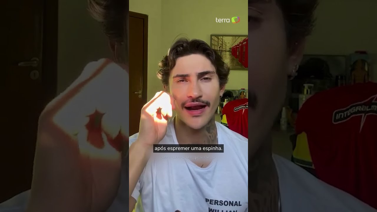 Espremer espinhas pode matar? Entenda o que é a ‘zona da morte’ do rosto #shorts