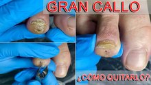 Cómo quitar esa molesta callosidad en el dedo del pie