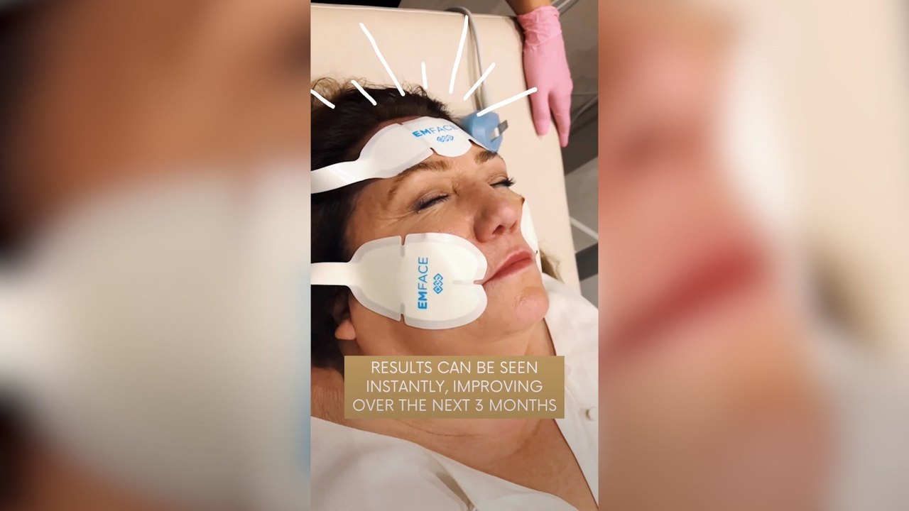 Arlene Phillips underwent an EmFace facelift: what is it?