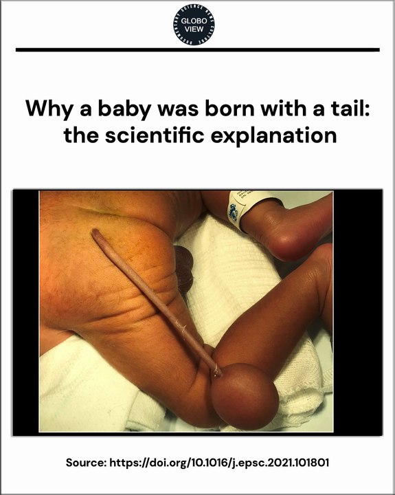 Why a baby was born with a tail: the scientific explanation