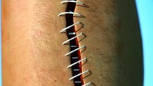 How Stitches Work 😯