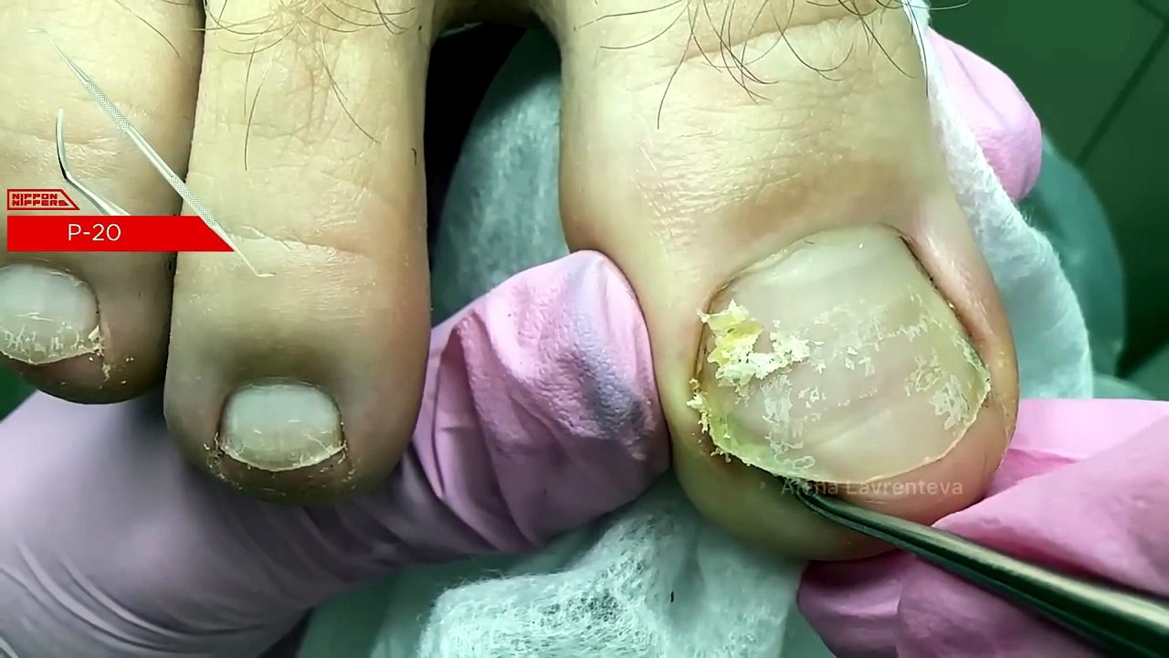 Men's Pedicure: What's That Weird Spot on Your Nail?