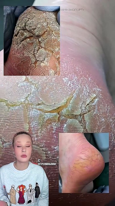 Cracked Heels Transformation: See the Progress After One Month