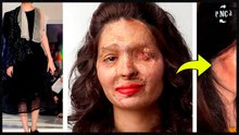 Modelo que perdió su rostro: así volvió a sonreír