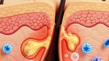 5 Cara Mencegah Bisul agar Tidak Bertambah Besar