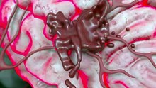 The Stroke That Made Him An Artist