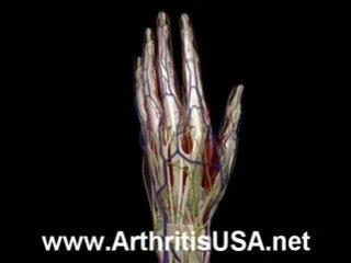 Dr Farshchian s Regenerative Medicine and Carpal Tunnel