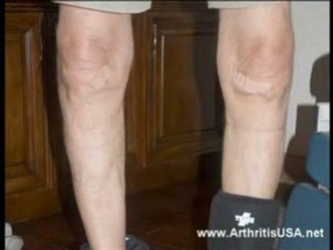 Dr Farshchian s Regenerative Medicine and Bowlegged Knees