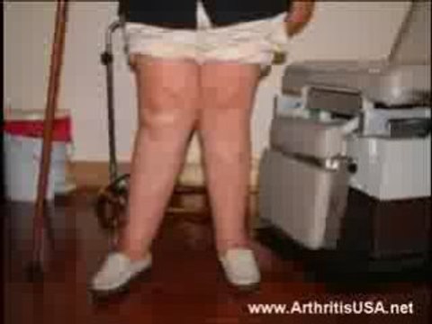 Dr Farshchian s Regenerative Medicine and Knocked Knees