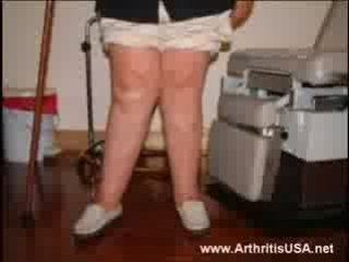 Dr Farshchian s Regenerative Medicine and Knocked Knees