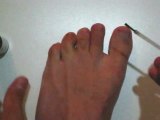 How To Treat Toenail Fungus, Natural Toenail Fungus Cure