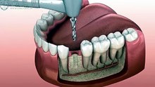 Animated Dental Implant Procedure _ Apollo Medical Travel