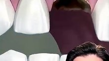 Tooth Implant Procedure {STEP BY STEP} - Explained