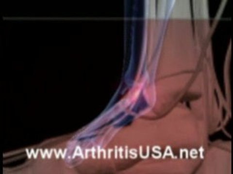 Dr Farshchian s Regenerative Medicine and AVN