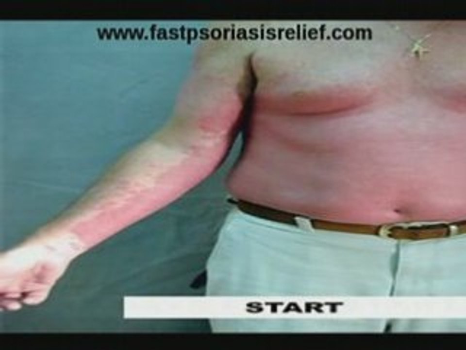 Fast Psoriasis Relief Treatment