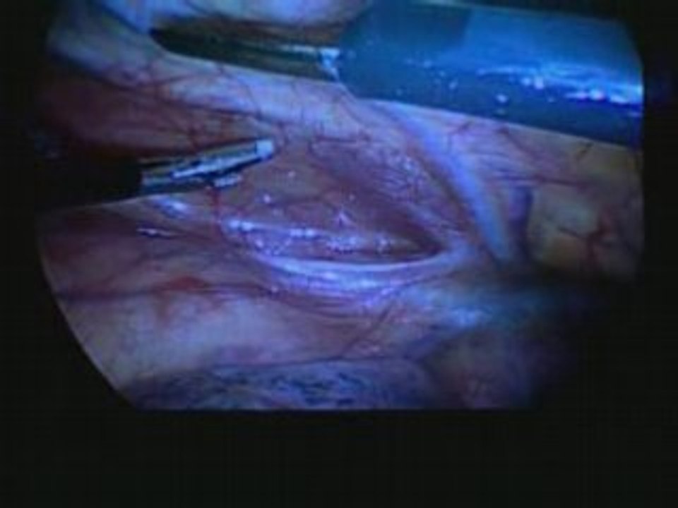 6831_0_Emory_Heart_Bypass