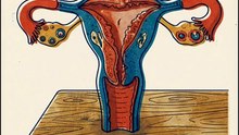 Cancro do útero O que é