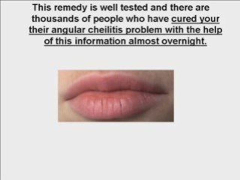 Natural Angular Cheilitis Cure