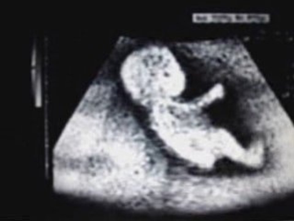 echographie schumacher