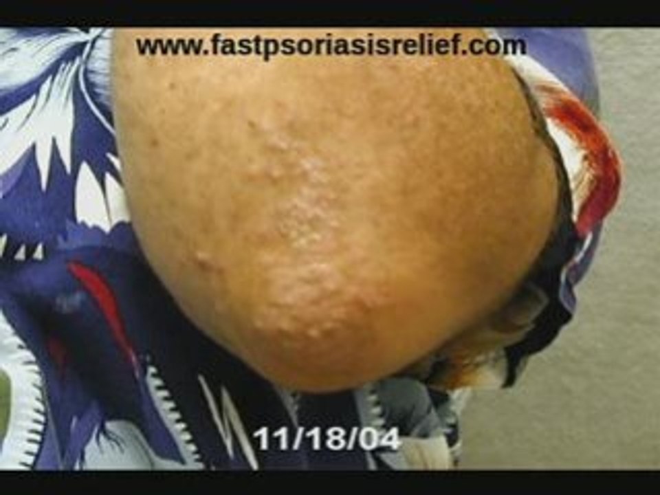 FSR Elbow