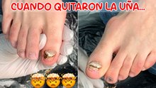 ¿Uñas de los pies desprendidas? Descubre por qué tuvieron que quitarlas en este vlog de uñas