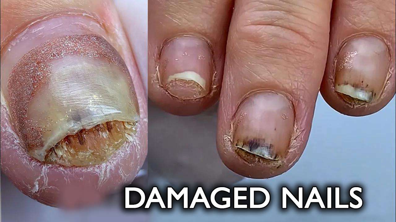 Gel Polish Made My Nails Thick and Yellow—What Now? How to Fix Damaged ...