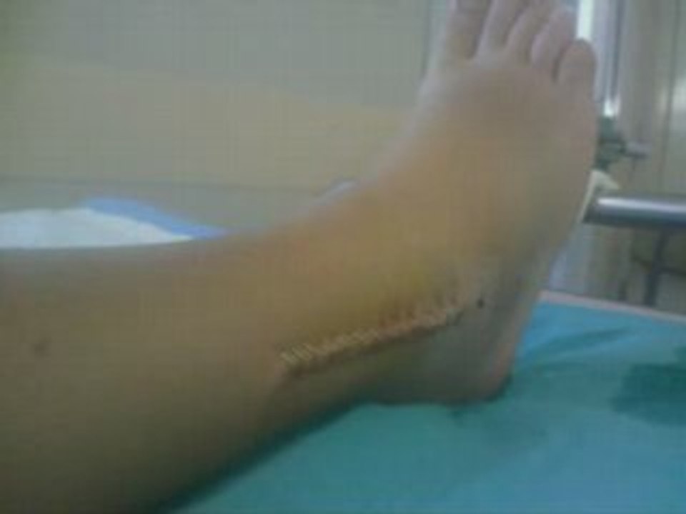 Fracture de la maleole