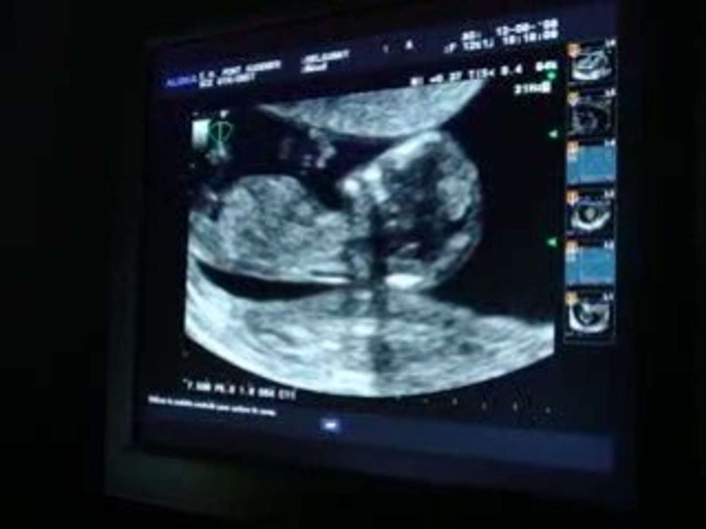 Echographie Des 12 Sa A 12 Sa 1 J Video Dailymotion