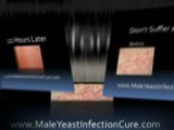 Male Yeast Infection treatment works in 12 hours
