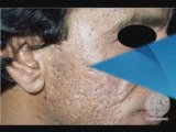 Acne Scars Treatments