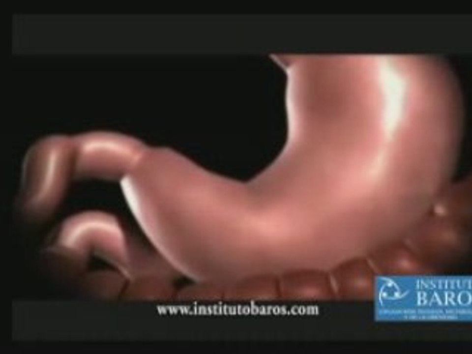 Cirugia de la Obesidad Manga Gastrica Argentina