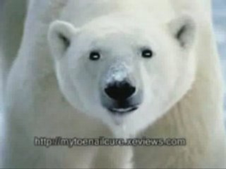 Top Toenail Fungus Remedies