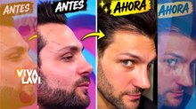 Nicola Porcella reaparece tras cirugía de naríz