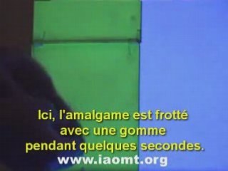 Amalgames dentaires : le mercure vous empoisonne