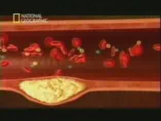 Infarto de miocardio: Factores de riesgo