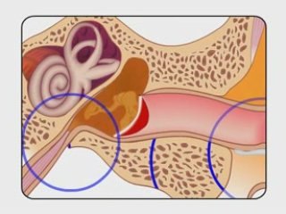 Ear infections and swimmers ear www.eardoc.info