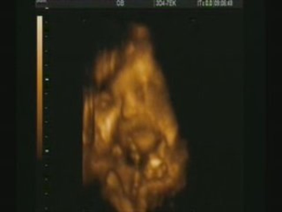 Echographie 3D du 15/07/2008