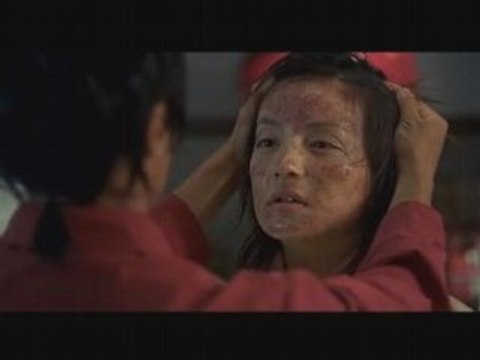 Pedro Boutons D'acné