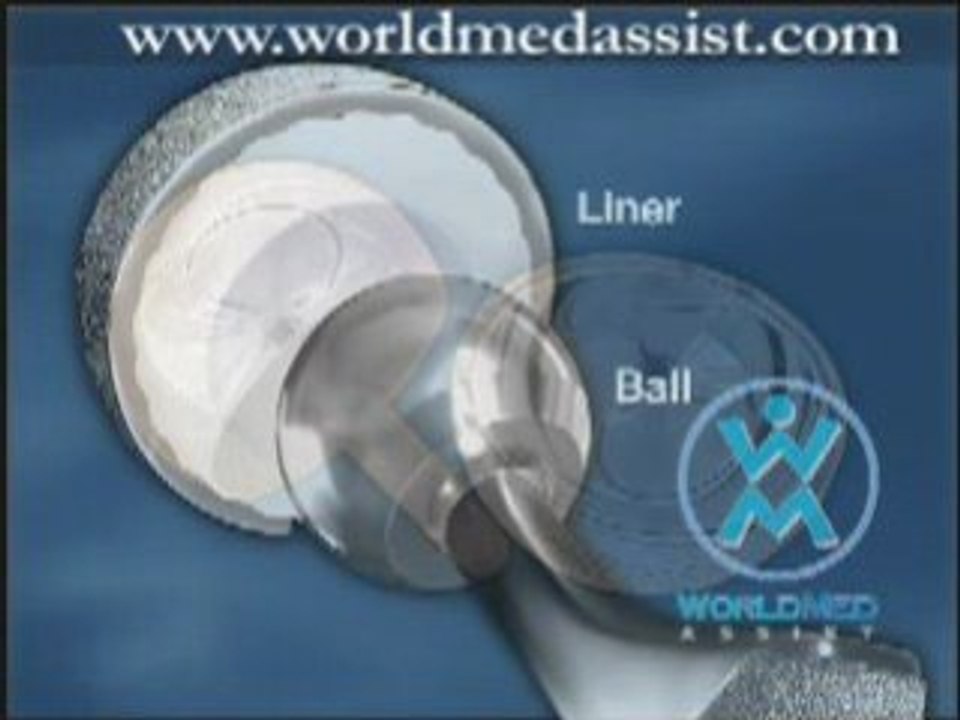 Birmingham Hip Resurfacing: Educational Video