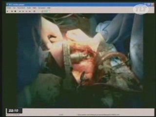 TLT Toulouse, le CHU Rangueil innove en implantant de nouveaux types de coeurs artifici