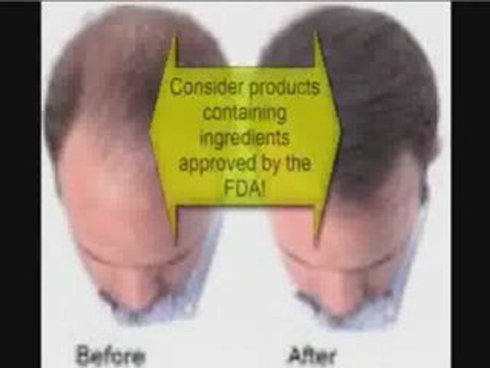 Trying to Find the Best Hair Thinning Remedy?