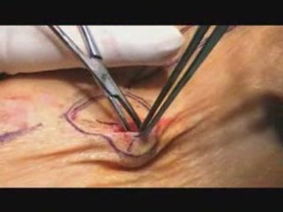 Varices eveinage1