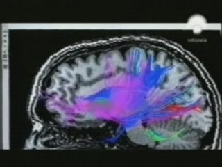 Alcohol y neuroimagen