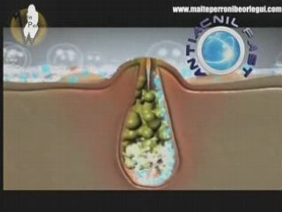 Maite y Anahí, anuncio de Asepxia