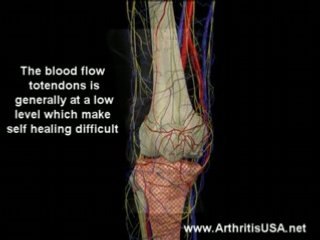 Dr Farshchian s Regenerative Medicine and Jumper's Knee