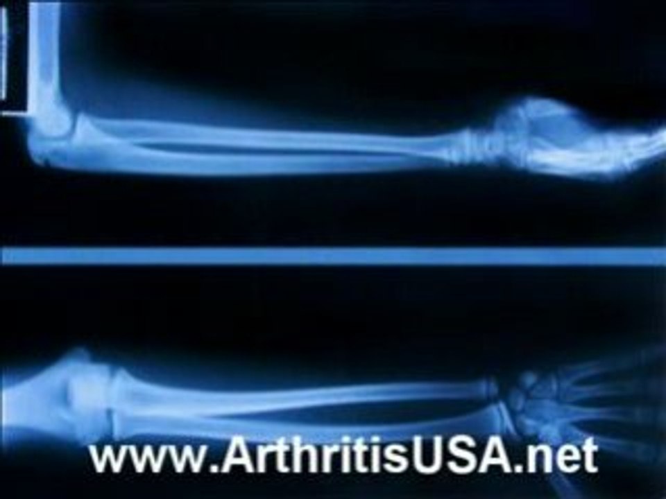 Dr Farshchian s Regenerative Medicine and golfer's elbow