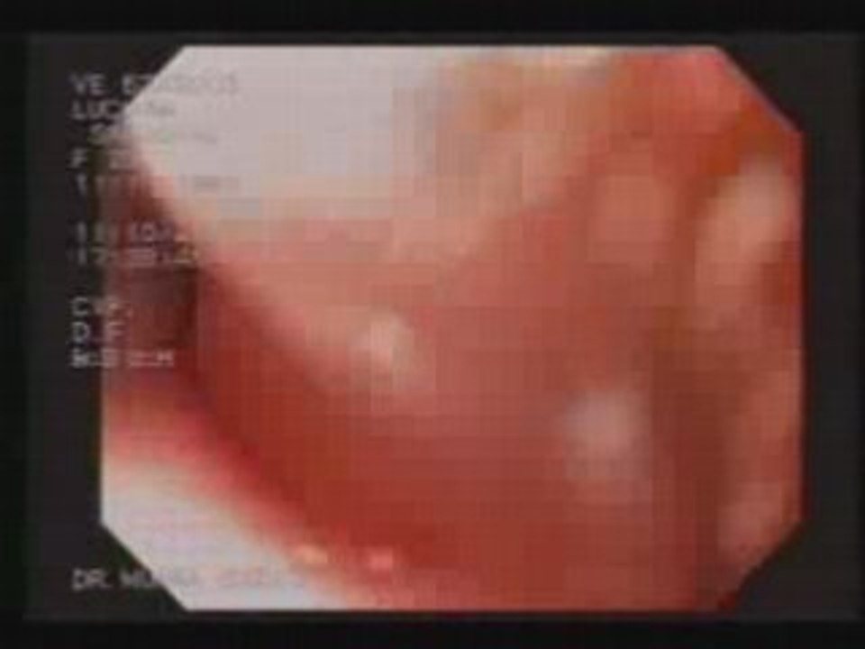 Endoscopía  parte 2