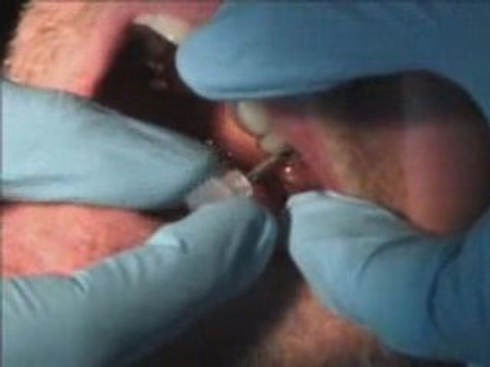 implant