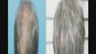 Provillus Hair Loss Before and After Pics